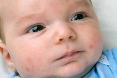 Baby Akne bei Neugeborenen - Neugebornenenakne