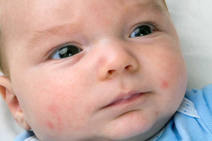 Baby Akne bei Neugeborenen - Neugebornenenakne